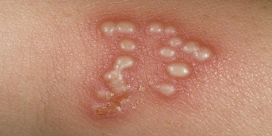 gejala penyakit herpes zoster