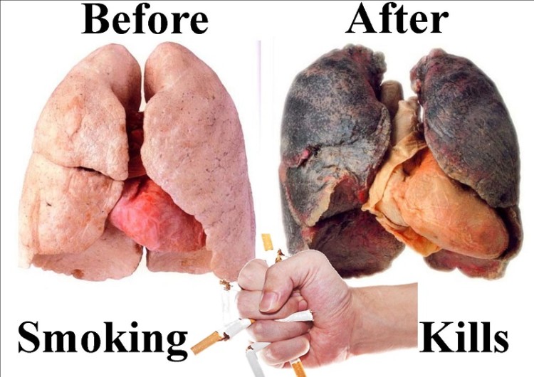 Bahaya Vapor Kanker Bahaya Vapor Kanker
